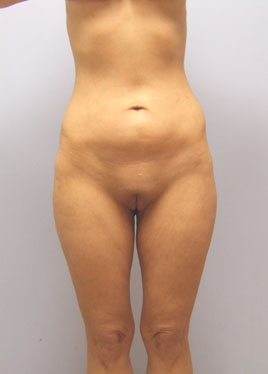 Thigh Lift Before & After Image