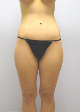 Thigh Lift Before & After Image