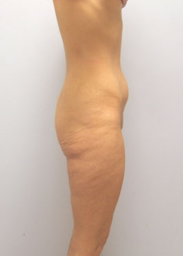 Thigh Lift Before & After Image