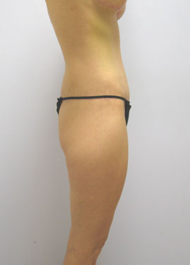 Thigh Lift Before & After Image