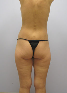 Thigh Lift Before & After Image