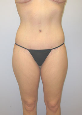 Thigh Lift Before & After Image