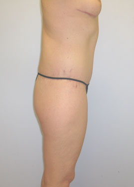 Thigh Lift Before & After Image