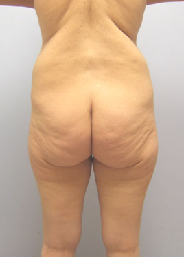 Thigh Lift Before & After Image