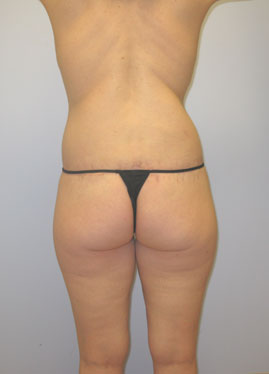 Thigh Lift Before & After Image