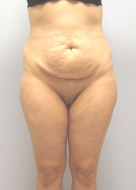 Thigh Lift Before & After Image