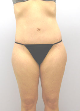 Thigh Lift Before & After Image