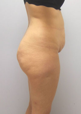 Thigh Lift Before & After Image