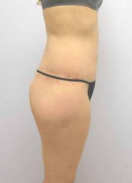 Thigh Lift Before & After Image