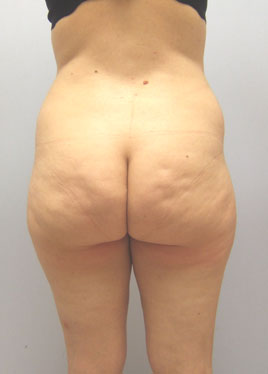 Thigh Lift Before & After Image