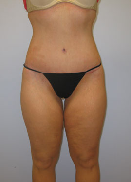 Thigh Lift Before & After Image