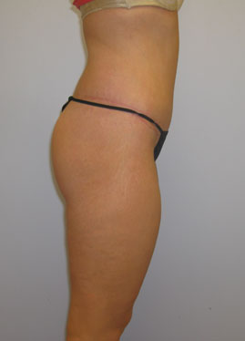 Thigh Lift Before & After Image