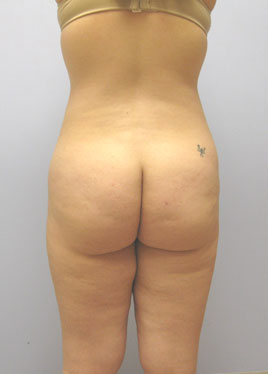 Thigh Lift Before & After Image