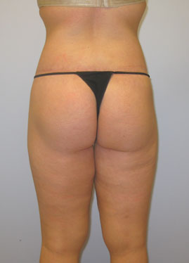 Thigh Lift Before & After Image