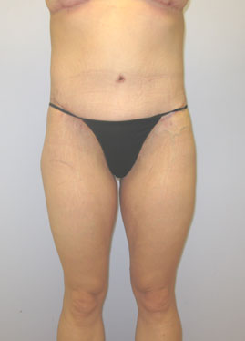 Thigh Lift Before & After Image