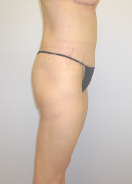 Thigh Lift Before & After Image