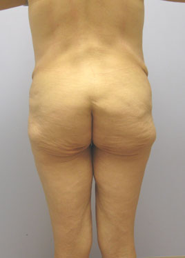 Thigh Lift Before & After Image