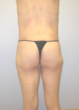 Thigh Lift Before & After Image