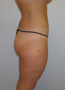 Thigh Lift Before & After Image