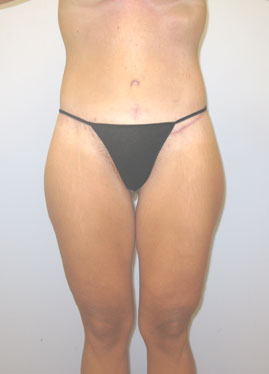 Thigh Lift Before & After Image