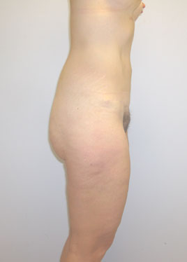 Thigh Lift Before & After Image