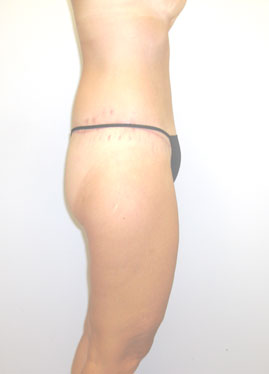 Thigh Lift Before & After Image