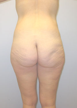 Thigh Lift Before & After Image