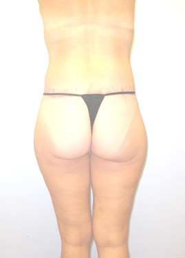 Thigh Lift Before & After Image