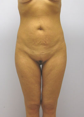 Thigh Lift Before & After Image