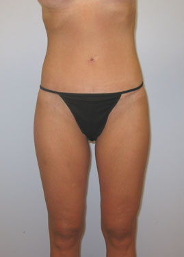 Thigh Lift Before & After Image