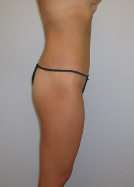 Thigh Lift Before & After Image