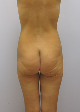 Thigh Lift Before & After Image