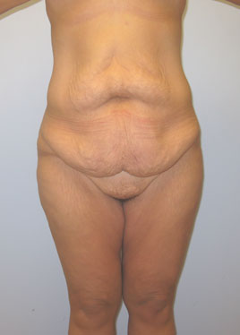 Thigh Lift Before & After Image