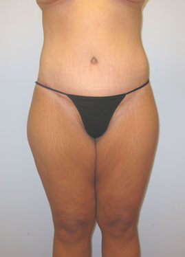 Thigh Lift Before & After Image