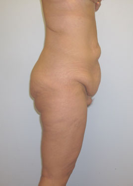 Thigh Lift Before & After Image