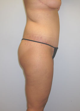 Thigh Lift Before & After Image