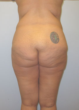 Thigh Lift Before & After Image