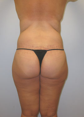 Thigh Lift Before & After Image