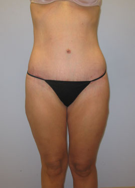 Thigh Lift Before & After Image