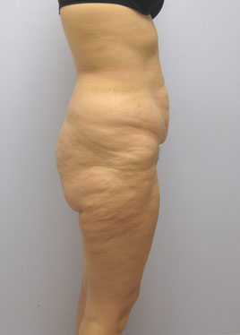 Thigh Lift Before & After Image