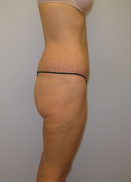 Thigh Lift Before & After Image