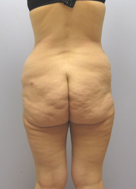 Thigh Lift Before & After Image