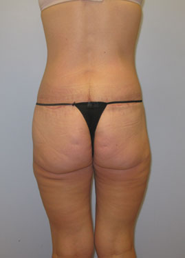 Thigh Lift Before & After Image