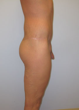 Thigh Lift Before & After Image