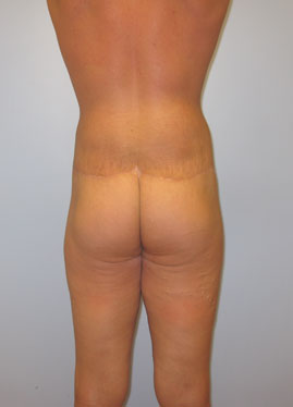 Thigh Lift Before & After Image