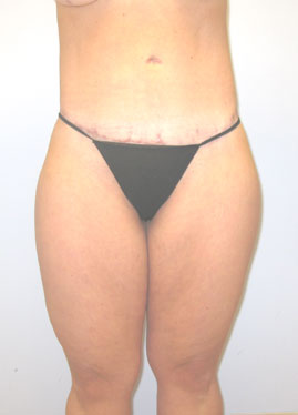 Thigh Lift Before & After Image