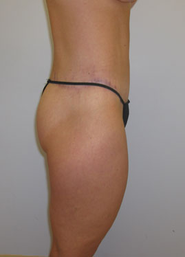 Thigh Lift Before & After Image