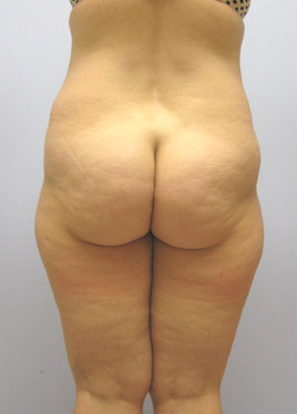 Thigh Lift Before & After Image