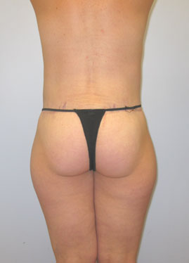 Thigh Lift Before & After Image