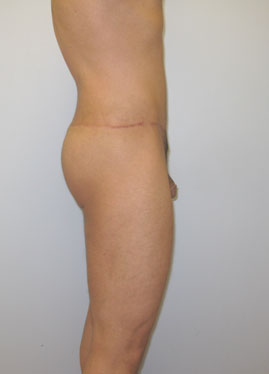 Thigh Lift Before & After Image